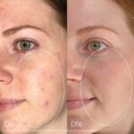 Caudalie – Vinopure Blemish Control Salicylic  Serum