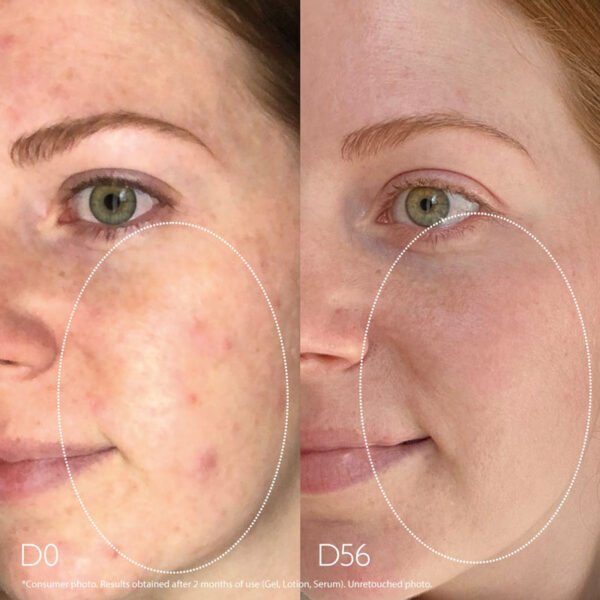 Caudalie – Vinopure Blemish Control Salicylic  Serum